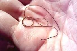 Parazit na dlanu vaše ruke