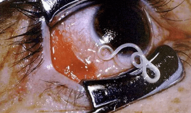 Vrste parazita u ljudskom tijelu